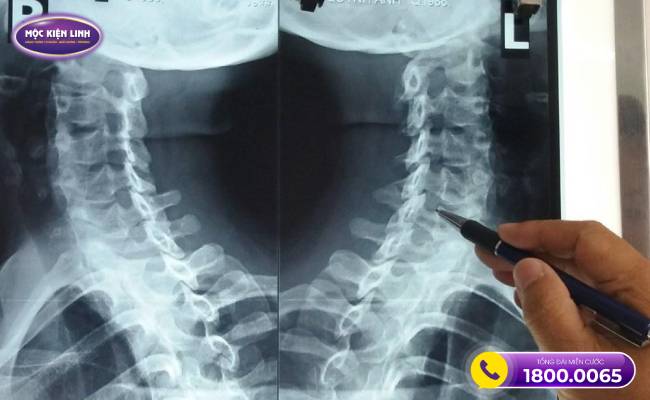 Chụp X-quang giúp chẩn đoán thoái hóa cột sống