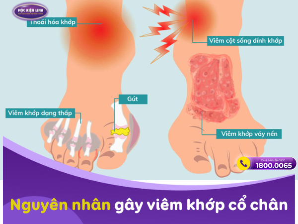 Nguyên nhân gây viêm khớp cổ chân là gì