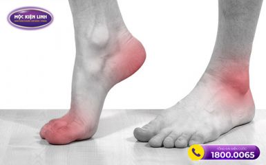 Nguyên nhân dẫn đến đau khớp cổ chân không sưng